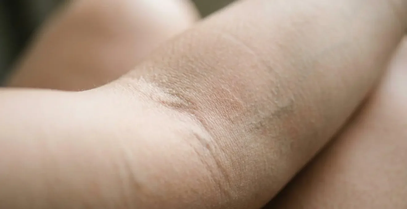 Gros plan sur la peau du pli du coude, zone recommandée pour le test d'allergie à la coloration.